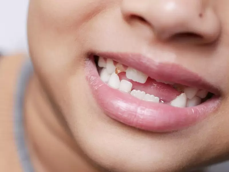 孩子乳牙搖晃要拔嗎？拔牙時機與方法詳解，家長必讀指南