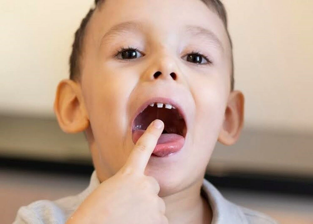 【家長必看】孩子門牙有縫怎麼辦？用兒童隱適美輕鬆關上門牙縫！