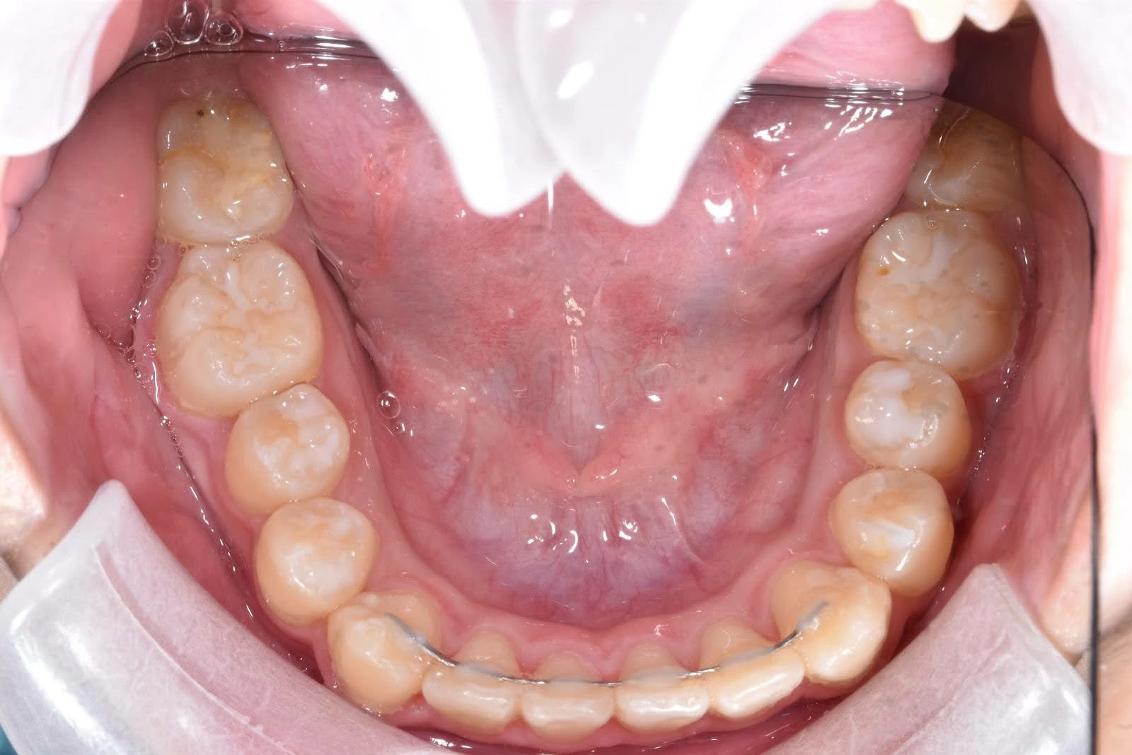 牙齒矯正後要選擇舌側維持器嗎？完整優缺點分析一次看懂