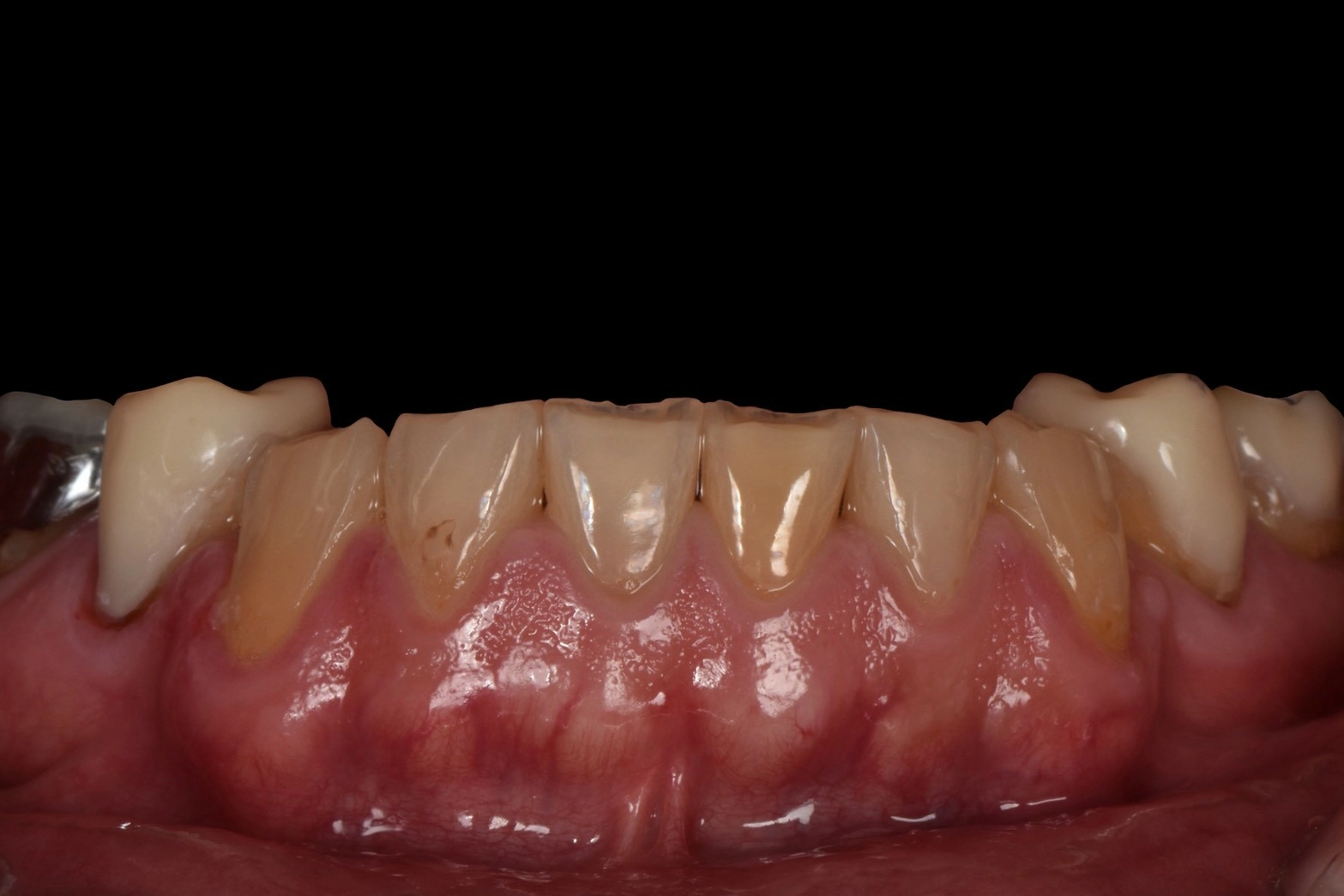 微矯正+人工琺瑯質修復