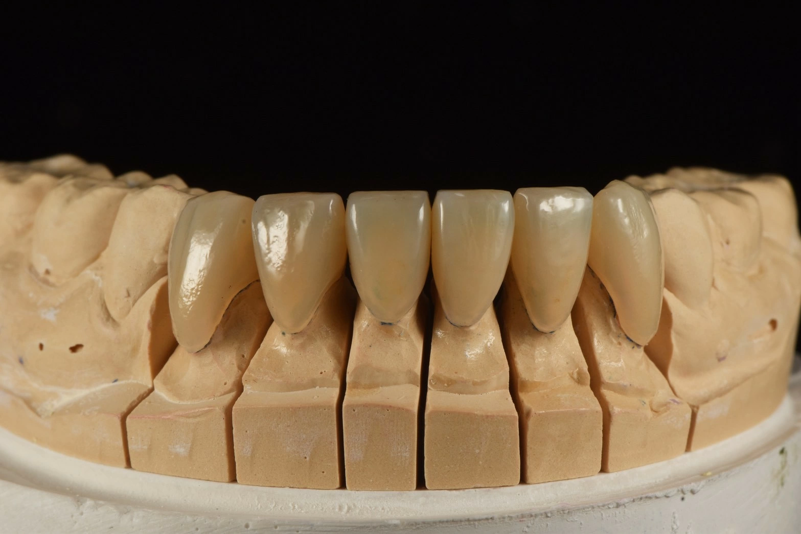 微矯正+人工琺瑯質修復