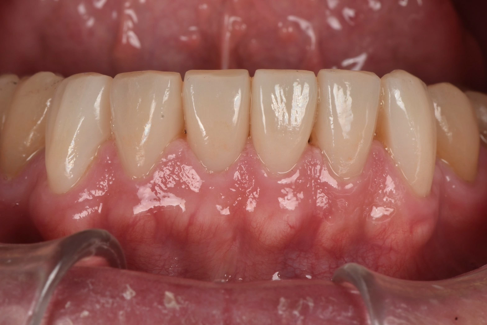 微矯正+人工琺瑯質修復