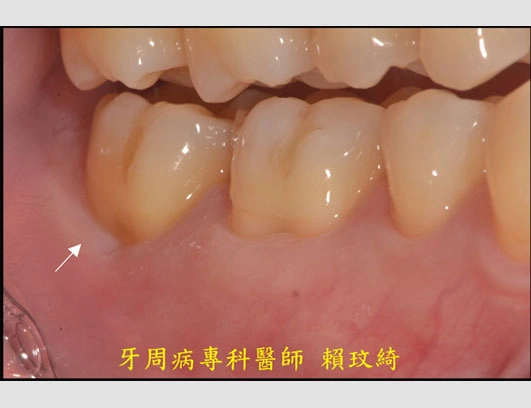 牙周再生手術+牙根覆蓋術