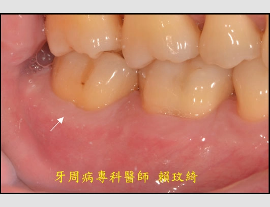 牙周再生手術+牙根覆蓋術