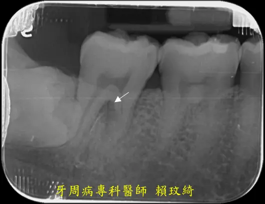 牙周再生手術+牙根覆蓋術