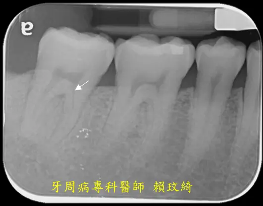 牙周再生手術+牙根覆蓋術
