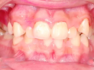 關於牙齒的咬合分類