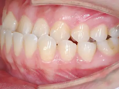 關於牙齒的咬合分類