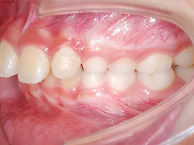 關於牙齒的咬合分類