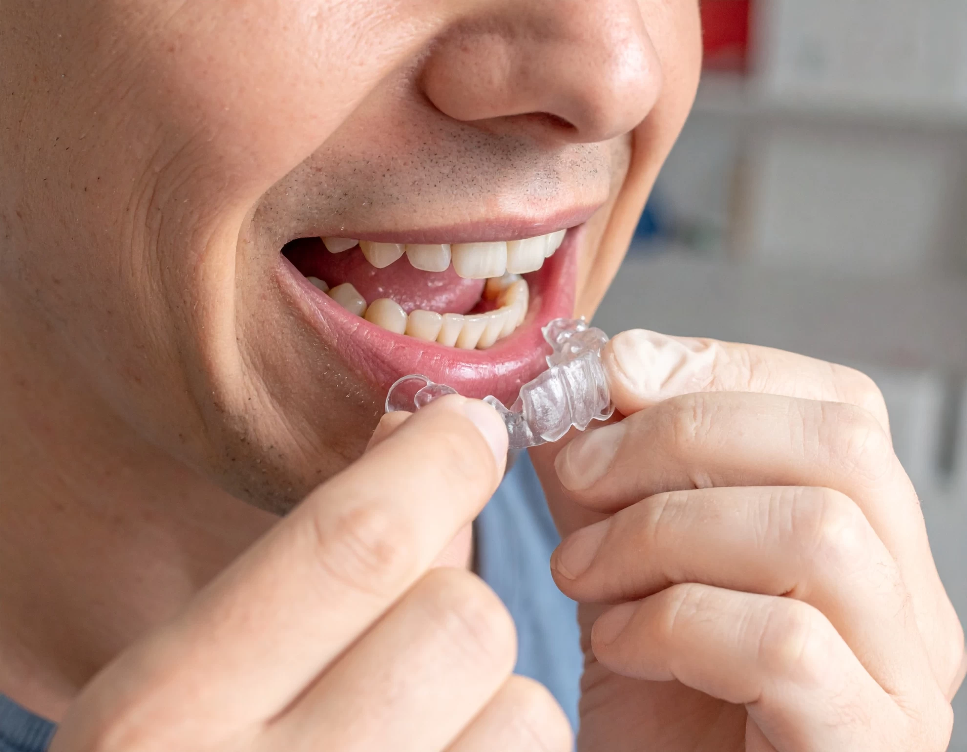 維持器戴不緊？牙醫分享 4 大正確佩戴步驟，避免矯正效果反彈