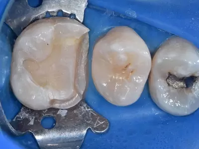 牙體復型科在做什麼？