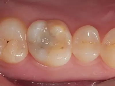 補牙從來不是一件小事—淺談複合樹脂填補