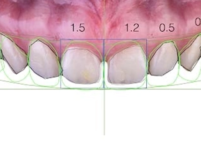 醫師醫師 我想要笑起來像候佩岑！ 淺談數位微笑設計