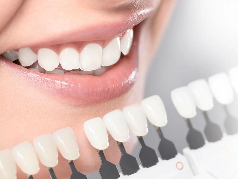 牙齒美白